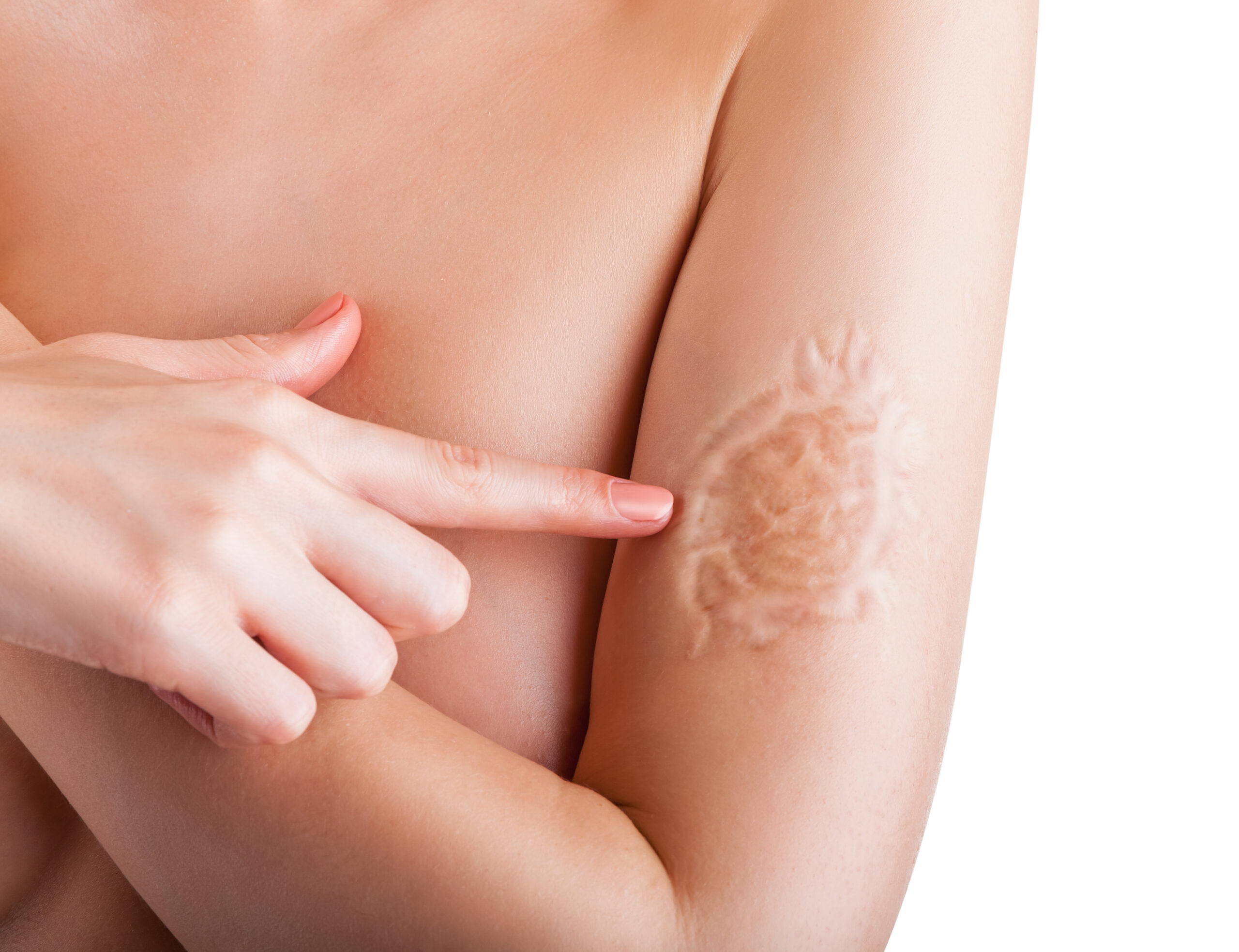 Woman is pointing a finger at the scar on his hand isolated on white background