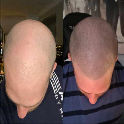 Before and after scalp micropigmentation smaller