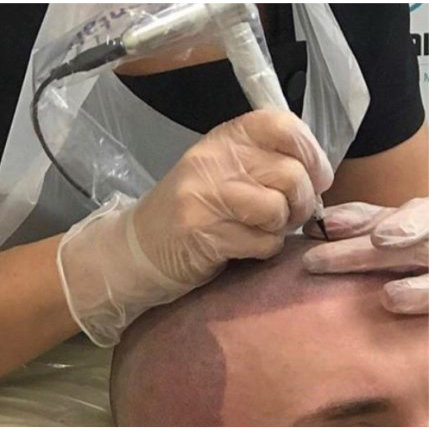 scalp pigmentation croped